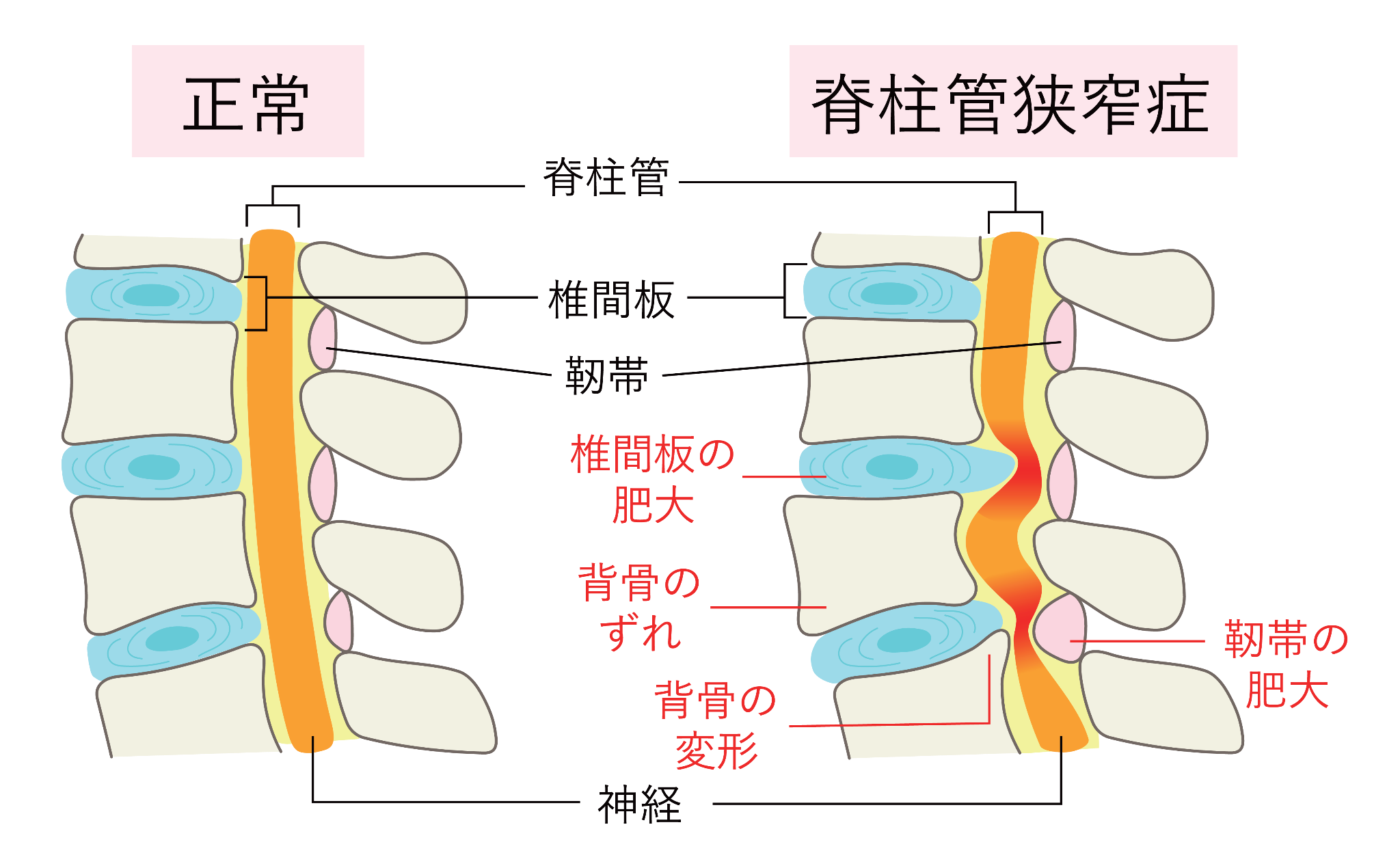 脊柱管狭窄症図①